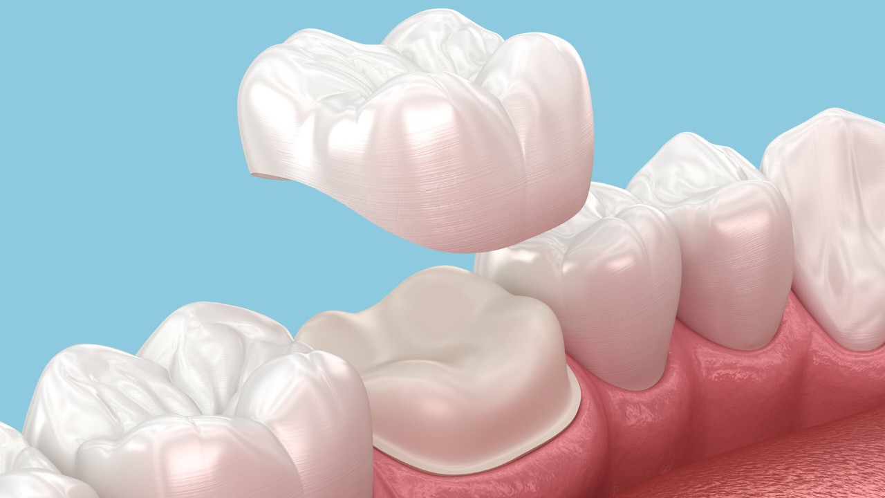 Ceramic Teeth Cap