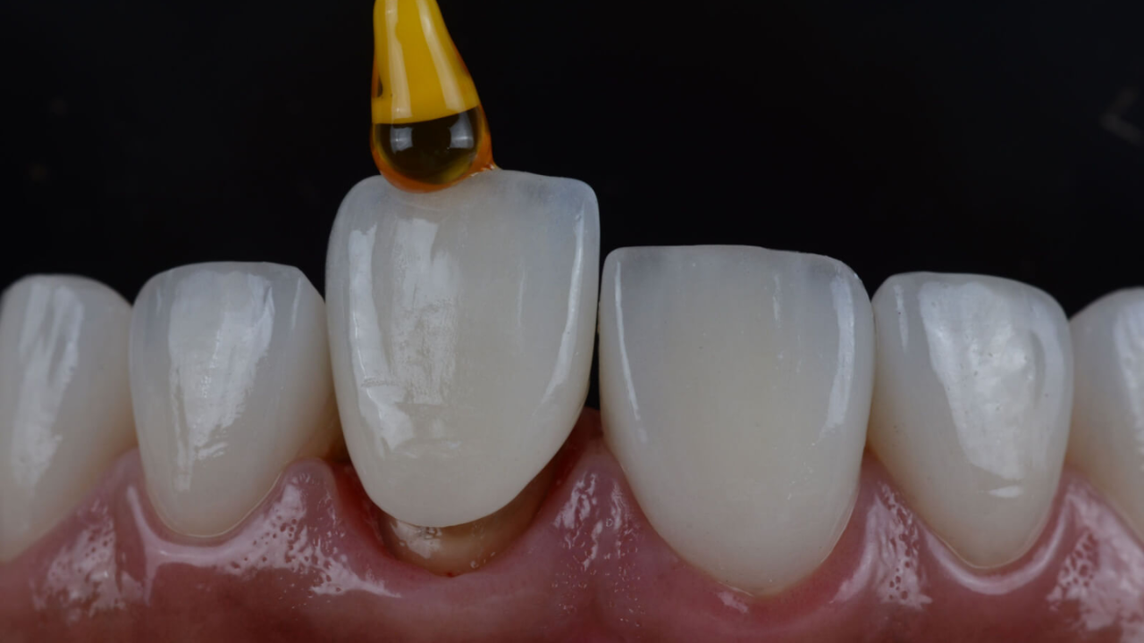 Ceramic Teeth Cap